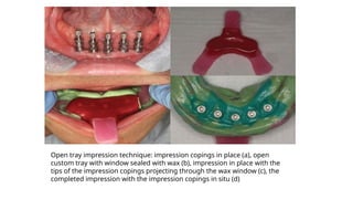Impression technique-in-implant-dentistry.pptx
