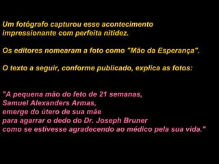 Um fotógrafo capturou esse acontecimento impressionante com perfeita nitidez.  Os editores nomearam a foto como "Mão da Esperança".  O texto a seguir, conforme publicado, explica as fotos:   "A pequena mão do feto de 21 semanas,  Samuel Alexanders Armas,  emerge do útero de sua mãe  para agarrar o dedo do Dr. Joseph Bruner  como se estivesse agradecendo ao médico pela sua vida." 