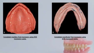 Impression in Complete Denture | PPTX