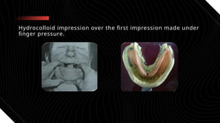 impression in distal extension rpd.pptx presentation seminar | PPTX