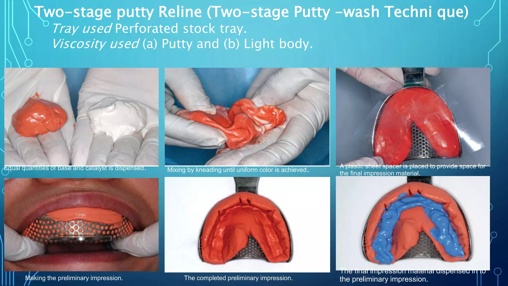 Two-stage putty Reline (Two-stage Putty -wash Techni que)
Tray used Perforated stock tray.
Viscosity used (a) Putty and (b) Light body.
Equal quantities of base and catalyst is dispensed. Mixing by kneading until uniform color is achieved. A plastic sheet spacer is placed to provide space for
the final impression material.
Making the preliminary impression. The completed preliminary impression.
The final impression material dispensed in to
the preliminary impression.
 