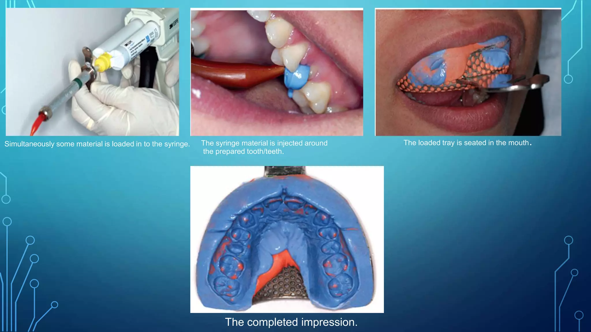 Simultaneously some material is loaded in to the syringe. The syringe material is injected around
the prepared tooth/teeth.
The loaded tray is seated in the mouth.
The completed impression.
 