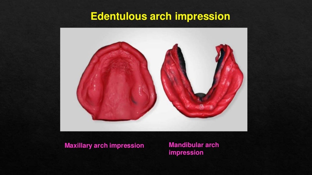 Impression materials classification and techniques