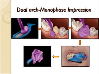 Dual arch-Monophase Impression
Dual arch-Monophase Impression
 