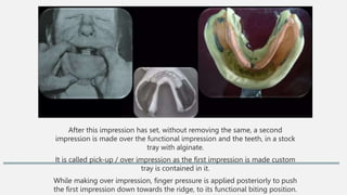 After this impression has set, without removing the same, a second
impression is made over the functional impression and the teeth, in a stock
tray with alginate.
It is called pick-up / over impression as the first impression is made custom
tray is contained in it.
While making over impression, finger pressure is applied posteriorly to push
the first impression down towards the ridge, to its functional biting position.
 