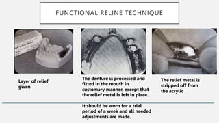FUNCTIONAL RELINE TECHNIQUE
Layer of relief
given
The denture is processed and
fitted in the mouth in
customary manner, except that
the relief metal is left in place.
It should be worn for a trial
period of a week and all needed
adjustments are made.
The relief metal is
stripped off from
the acrylic
 