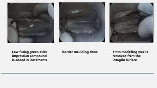 Low fusing green-stick
impression compound
is added in increments
Border moulding done 1mm modelling wax is
removed from the
intaglio surface
 