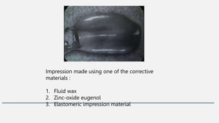 Impression made using one of the corrective
materials :
1. Fluid wax
2. Zinc-oxide eugenol
3. Elastomeric impression material
 
