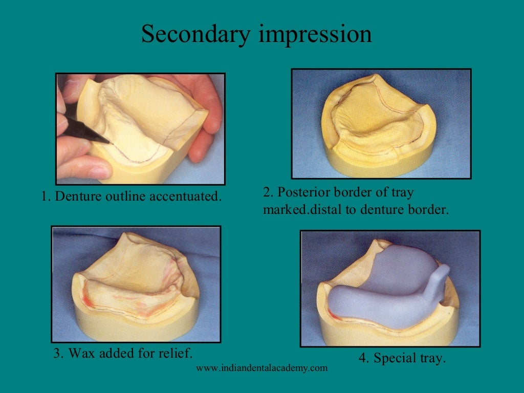 Impression procedures comlete denture/dental courses