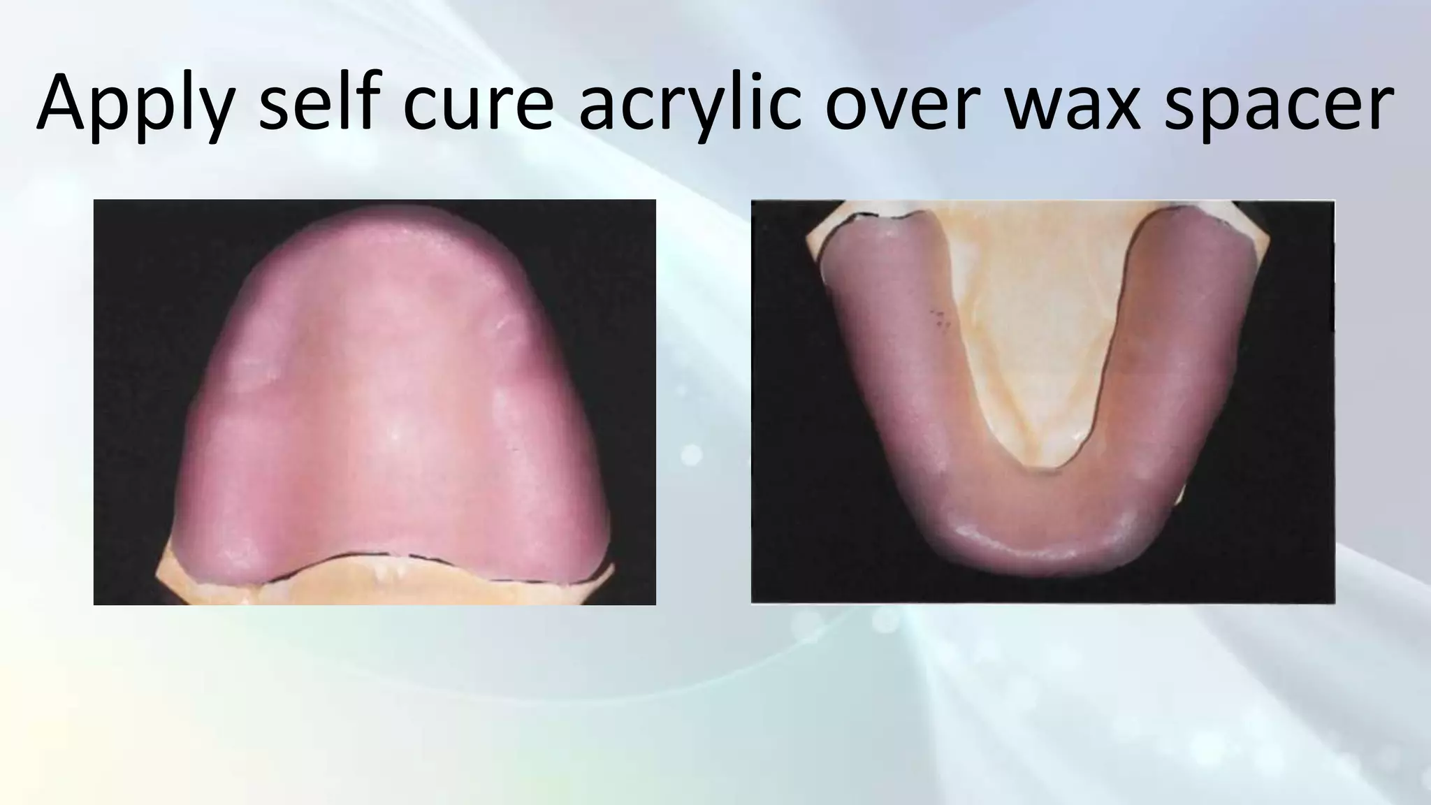 Apply self cure acrylic over wax spacer
 