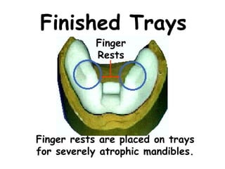 Finished Trays
            Finger
            Rests




Finger rests are placed on trays
for severely atrophic mandibles.
 