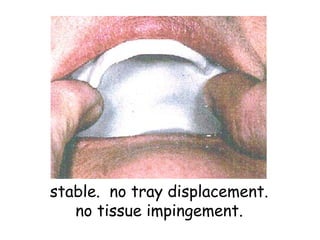 stable. no tray displacement.
   no tissue impingement.
 
