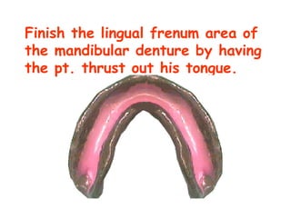 Finish the lingual frenum area of
the mandibular denture by having
the pt. thrust out his tongue.
 