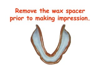 Remove the wax spacer
prior to making impression.
 