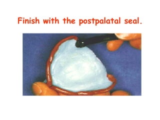 Finish with the postpalatal seal.
 