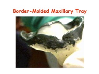 Border-Molded Maxillary Tray
 