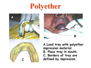 Polyether
A




                              B

           A.Load tray with polyether
           impression material.
           B. Place tray in mouth.
           C. Borders of tray are
    C      defined by impression.
 