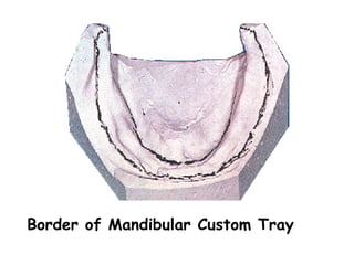 Border of Mandibular Custom Tray
 