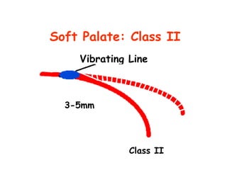 Soft Palate: Class II
    Vibrating Line



  3-5mm




              Class II
 