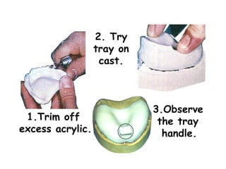 2. Try
                  tray on
                   cast.



                            3.Observe
 1.Trim off                  the tray
excess acrylic.               handle.
 