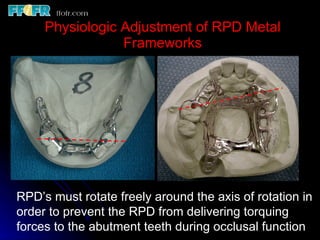 Rotational Rpd Impressions and physiologic adjustment | PPT