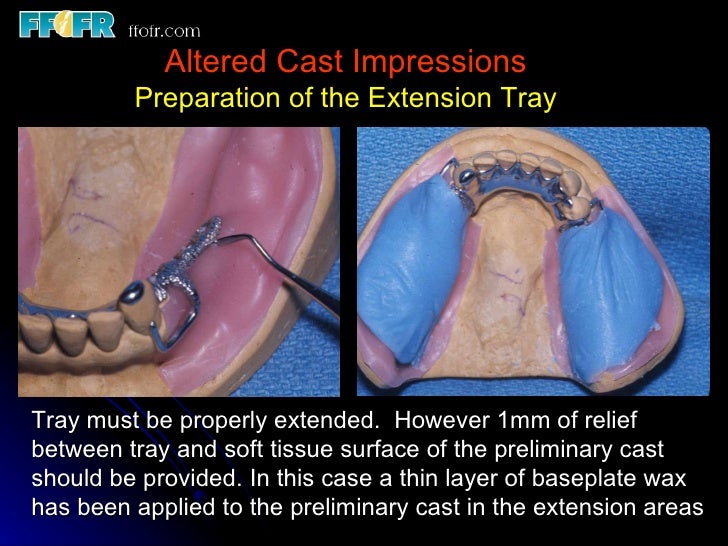 impressions and physiologic adjustment altered cast technique