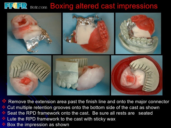altered cast technique