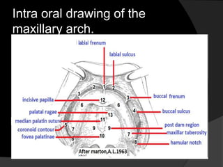 Intra oral drawing of the 
maxillary arch. 
 