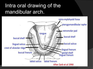 Intra oral drawing of the 
mandibular arch. 
 