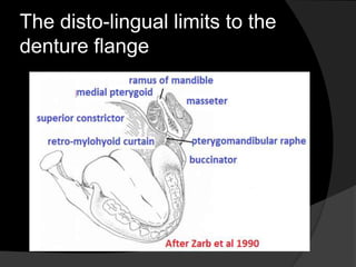 The disto-lingual limits to the 
denture flange 
 