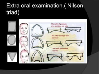 Extra oral examination.( Nilson 
triad( 
 
