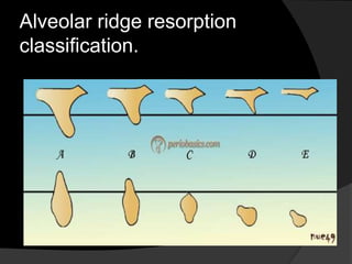 Alveolar ridge resorption 
classification. 
 