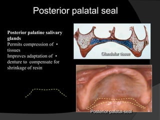 Posterior palatal seal 
Posterior palatine salivary 
glands 
Permits compression of • 
tissues 
Improves adaptation of • 
denture to compensate for 
shrinkage of resin 
Glandular tissue 
Posterior palatal seal 
 