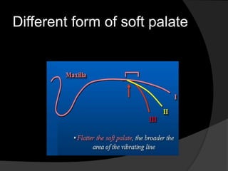 Different form of soft palate 
 