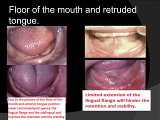 Floor of the mouth and retruded 
tongue. 
 