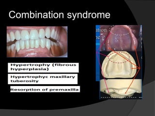 Combination syndrome 
 