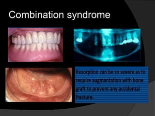 Combination syndrome 
 