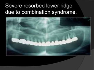 Severe resorbed lower ridge 
due to combination syndrome. 
 