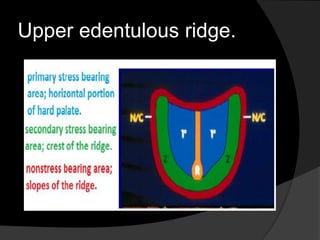 Upper edentulous ridge. 
 