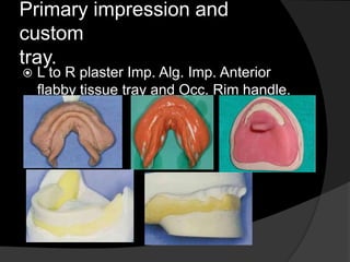 Primary impression and 
custom 
tray. 
 L to R plaster Imp. Alg. Imp. Anterior 
flabby tissue tray and Occ. Rim handle. 
 