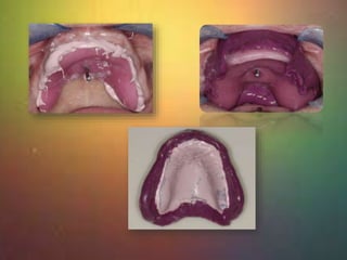 • The tray is seated in mouth labial 
and lingual borders are border 
molded with putty 
• Areas of overextension indicate...