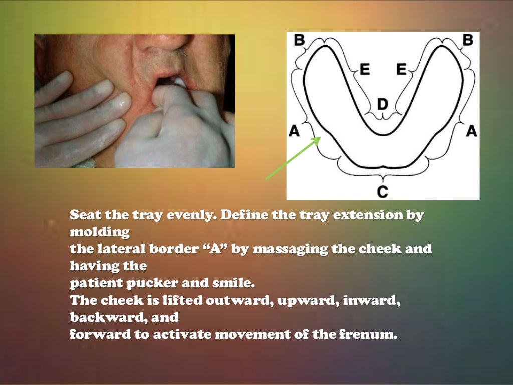 Impressions in complete dentures