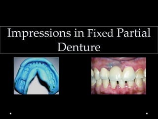 Impressions in Fixed Partial
Denture
 