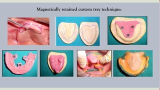 Tissue Ridges impression technique in complete denture seminar ppt.pptx