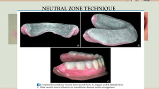impression technique in complete denture seminar ppt.pptx