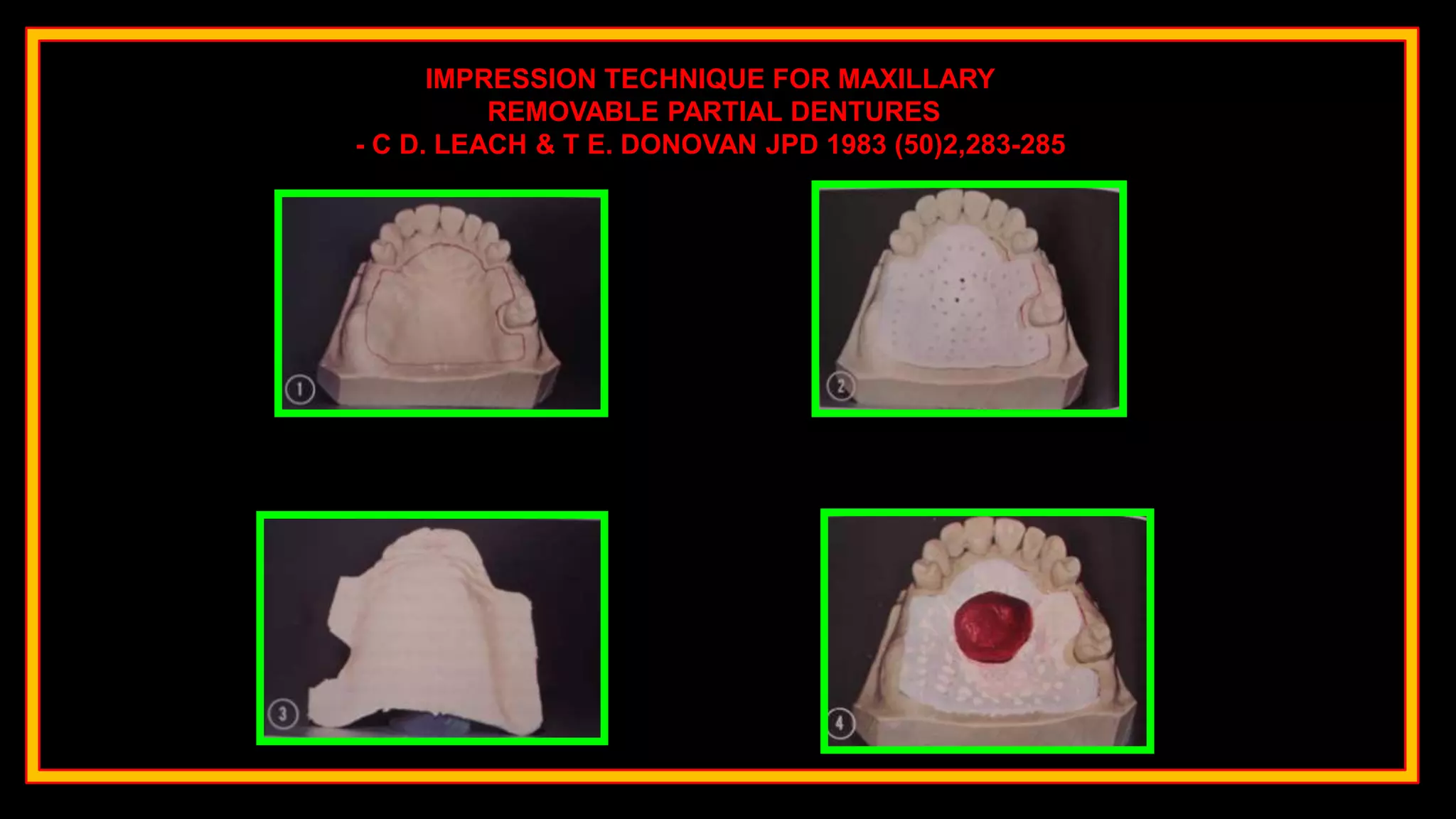 IMPRESSION TECHNIQUE FOR MAXILLARY
REMOVABLE PARTIAL DENTURES
- C D. LEACH & T E. DONOVAN JPD 1983 (50)2,283-285
 