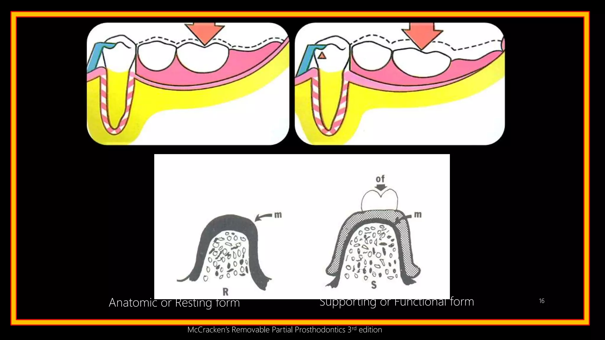 16
Anatomic or Resting form Supporting or Functional form
McCracken’s Removable Partial Prosthodontics 3rd edition
 