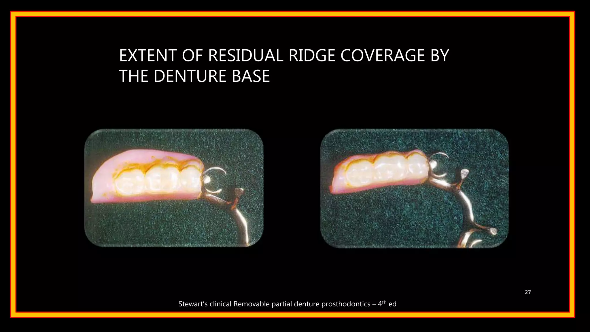 EXTENT OF RESIDUAL RIDGE COVERAGE BY
THE DENTURE BASE
27
Stewart’s clinical Removable partial denture prosthodontics – 4th ed
 
