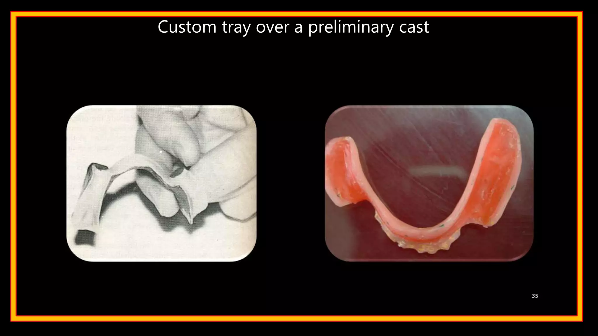 Custom tray over a preliminary cast
35
 