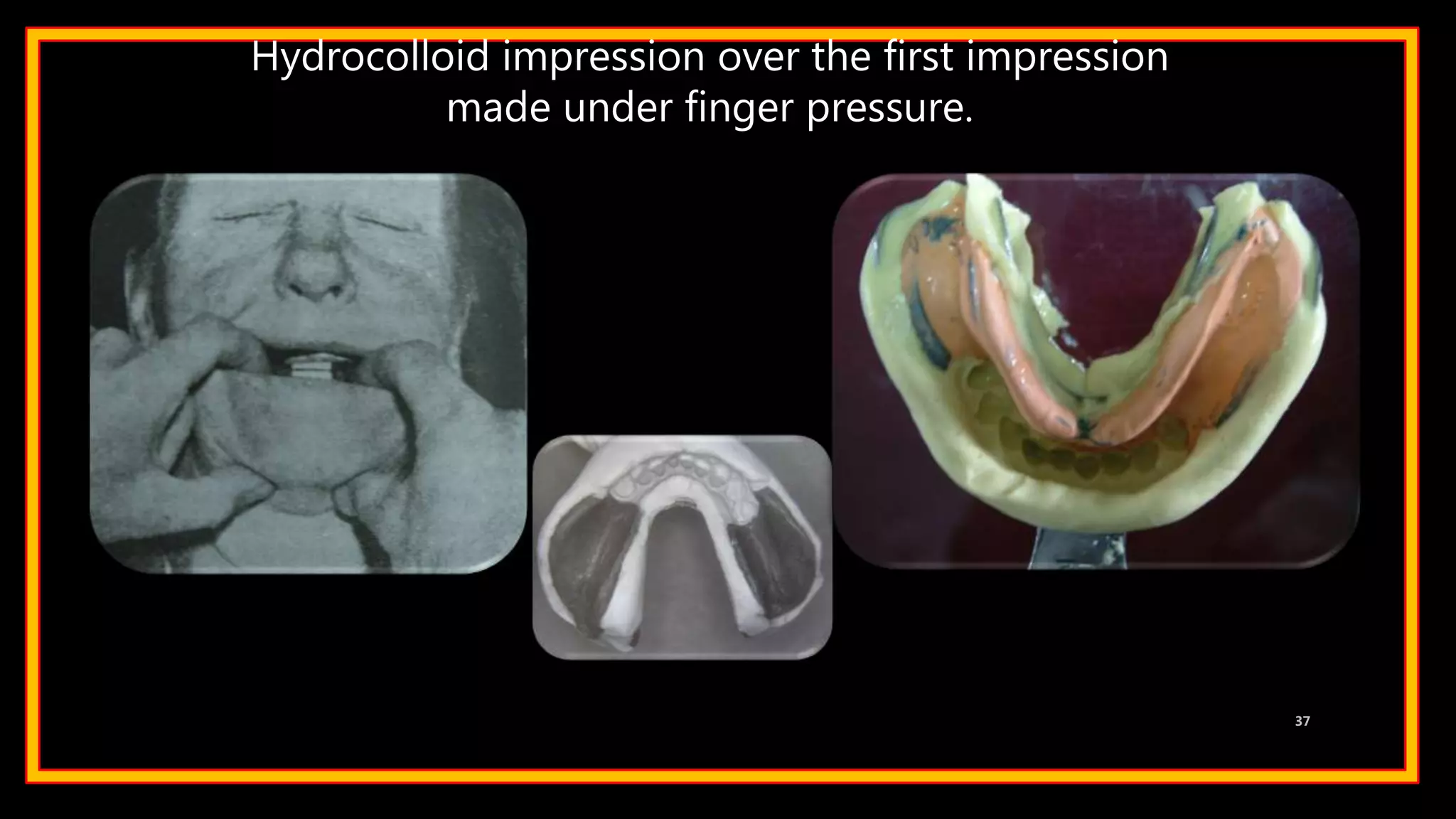 Hydrocolloid impression over the first impression
made under finger pressure.
37
 